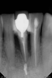 Owandy Opteo Digital Intraoral X-Ray Sensor