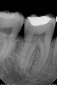 Owandy Opteo Digital Intraoral X-Ray Sensor