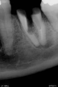 Owandy Opteo Digital Intraoral X-Ray Sensor