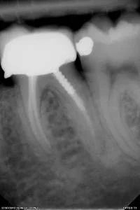 Owandy Opteo Digital Intraoral X-Ray Sensor