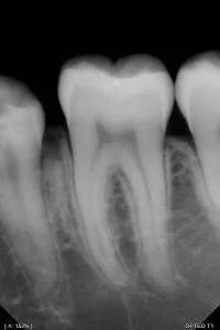 Owandy Opteo Digital Intraoral X-Ray Sensor