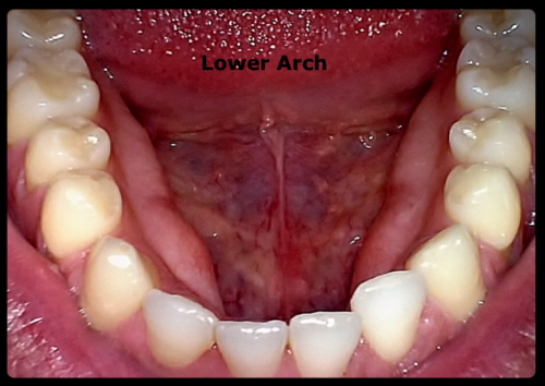 Sota Imaging - Claris i5HD Aluminum Intraoral Camera