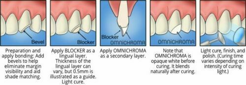 Tokuyama Blocker 6x Omnichroma 1 Shade Resin-Based Rest.  0.2g x20 PLT